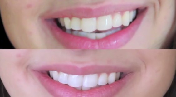 Whiten Your Teeth For Two Minutes Using Only Two Low-Priced Ingredients