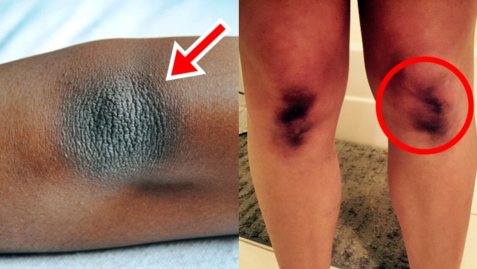 How To Lighten Dark Elbows And Knees Naturally And Effectively – Must See