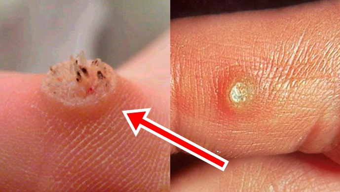 Cheapest Way To Remove Warts – Everyone Needs To Know This