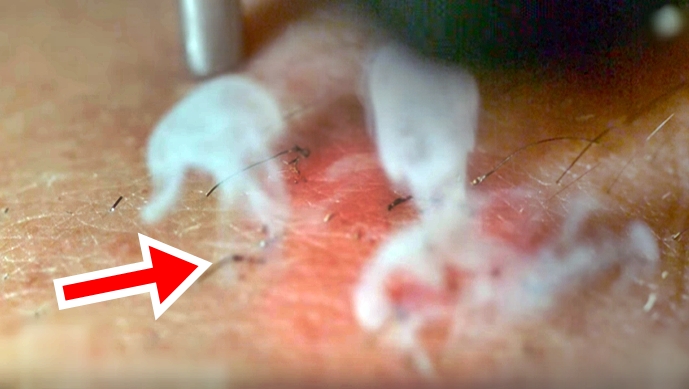 What Laser Hair Removal Looks Like In Slow Motion – Must See