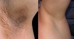 Safe Home Remedies To Get Rid Of Dark Underarms